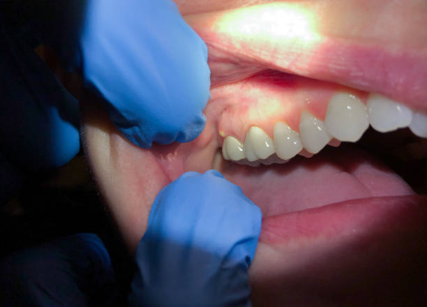 Best Emergency Dentist for Lost Fillings or Crowns in Copperas Cove, TX